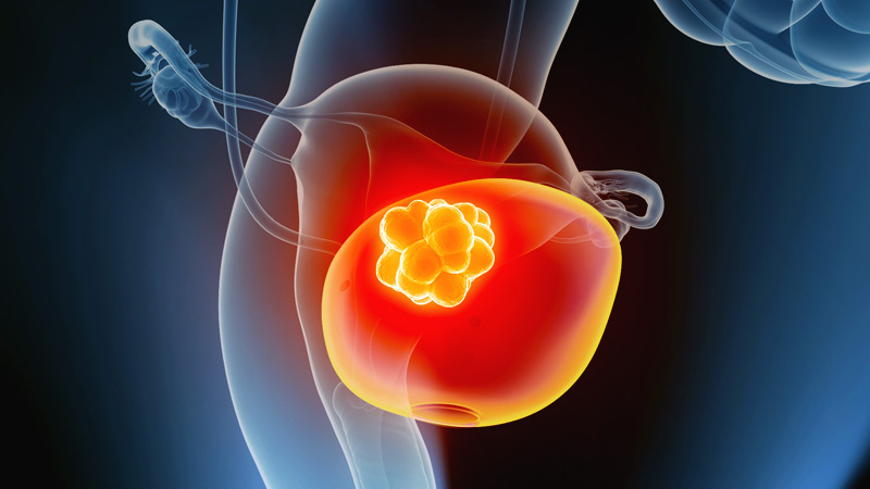 Bladder Cancer – Malignancy in the urinary tracts